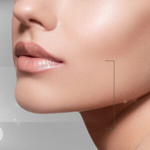 Gynecoplasty