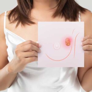 Unilateral breast lump