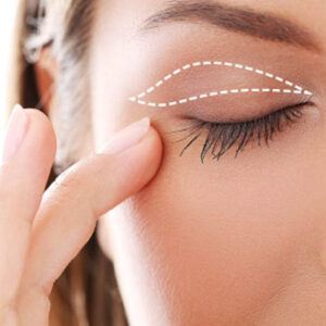 Blepharoplasty with anesthesia