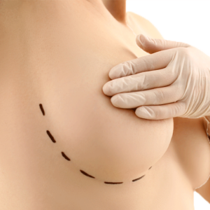mastopexy