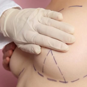 Mammoplasty