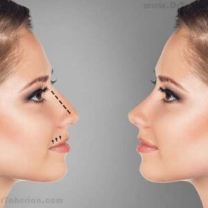 Septorhinoplasty