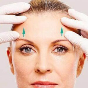 forehead lift